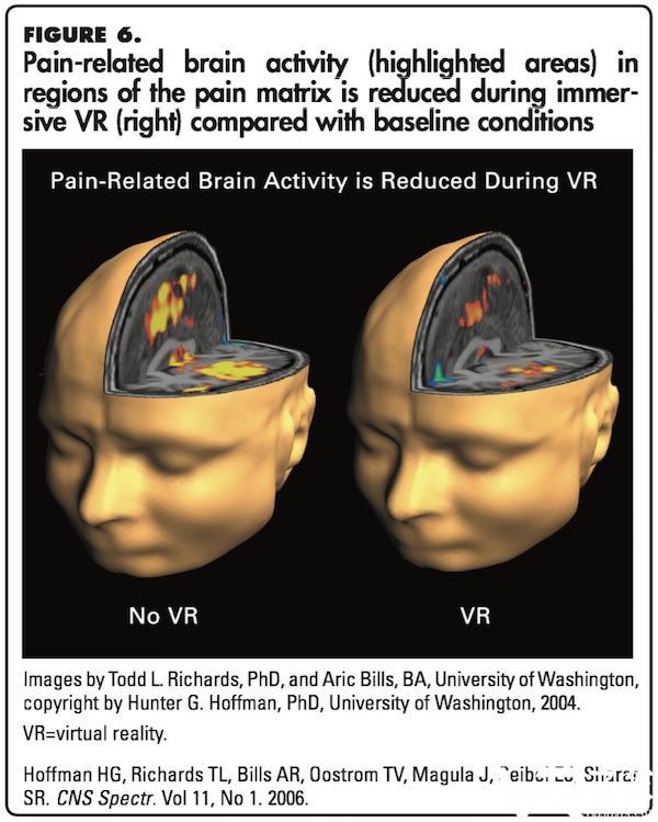 VR大法好! 研究显示VR镇痛效果是吗啡的两倍2.jpg